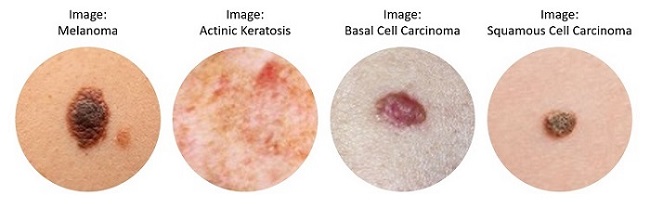 Images of Melanoma, Actinic Keratosis, Basal Cell Carcinoma, Squamous  Cell Carcinoma